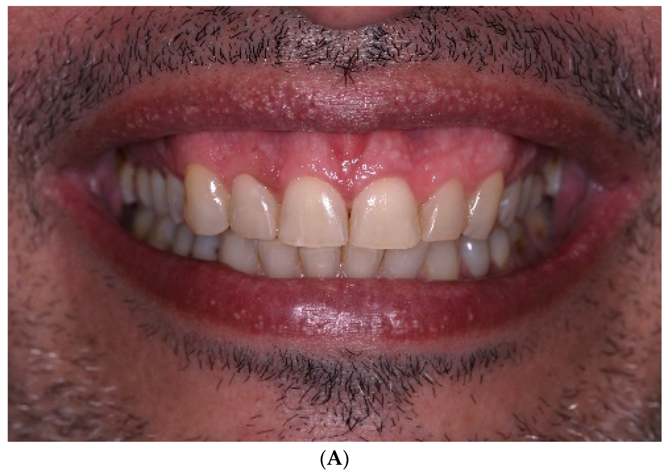 Applied Sciences Free Full Text Modified Lip Repositioning Surgery