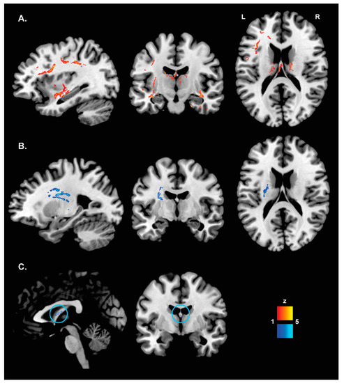 Macrostructural And Microstructural White Matter Alterations Are