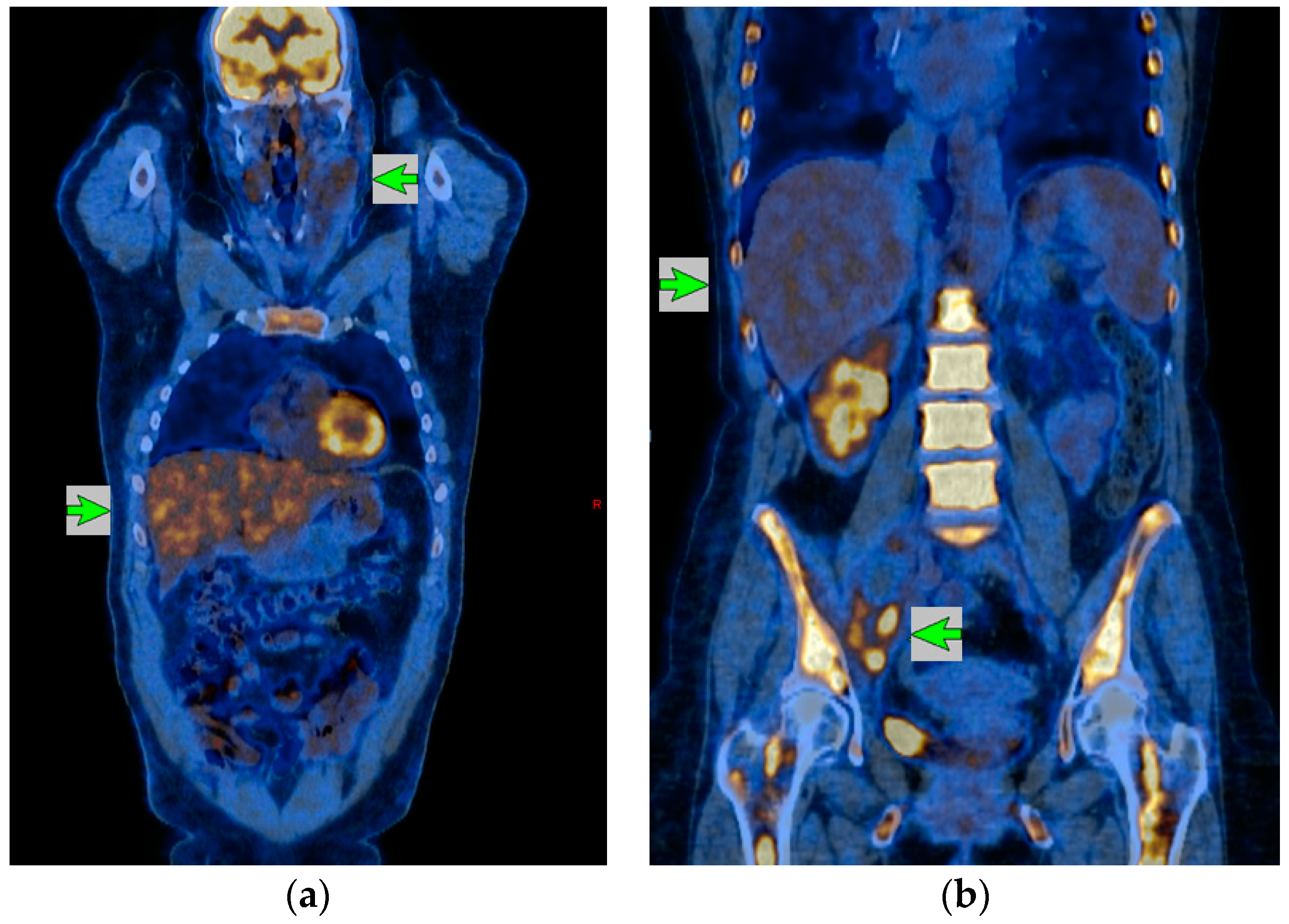 Cancers Free Full Text 18f Fdg Petct In Hodgkin Lymphoma Current