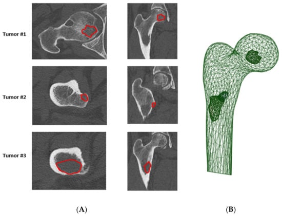 Cancers Free Full Text Fracture Risk Evaluation Of Bone Metastases A Burning Issue