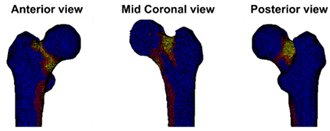 Cancers Free Full Text A Patient Specific Fracture Risk Assessment Tool For Femoral Bone