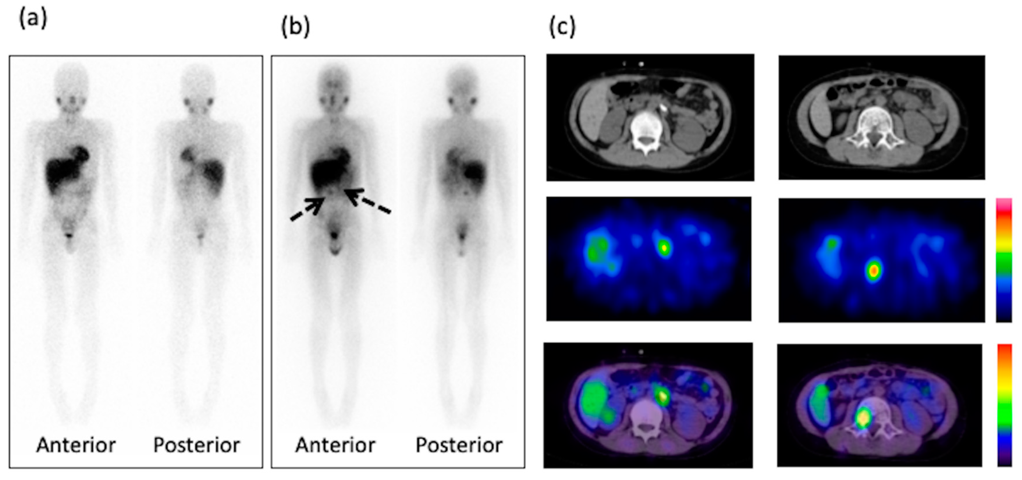 Diagnostics Free Full Text Diagnostic Use Of Post Therapy 131I Meta