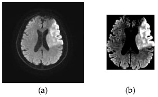 Diagnostics Free Full Text Automatic Assessment Of ASPECTS Using