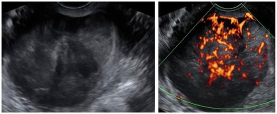 Diagnostics Free Full Text Ultrasound Guided Trans Uterine Cavity Core Needle Biopsy Of