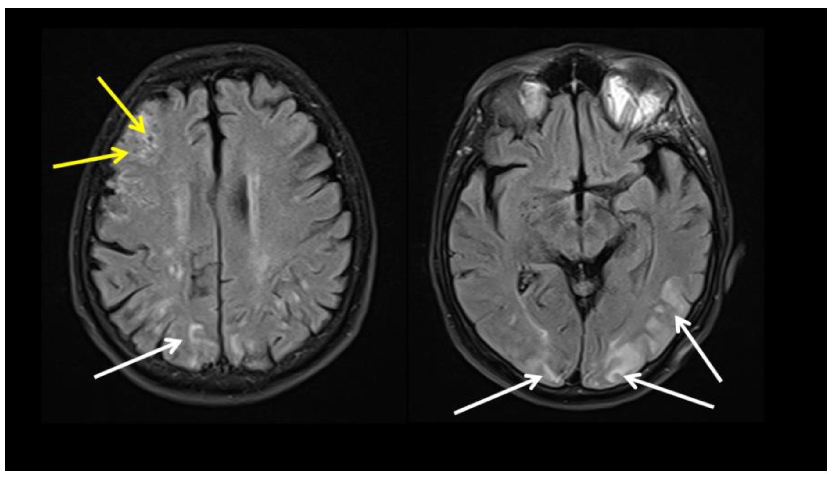 Large Vessel Giant Cell Arteritis Following Covid What Can Hla