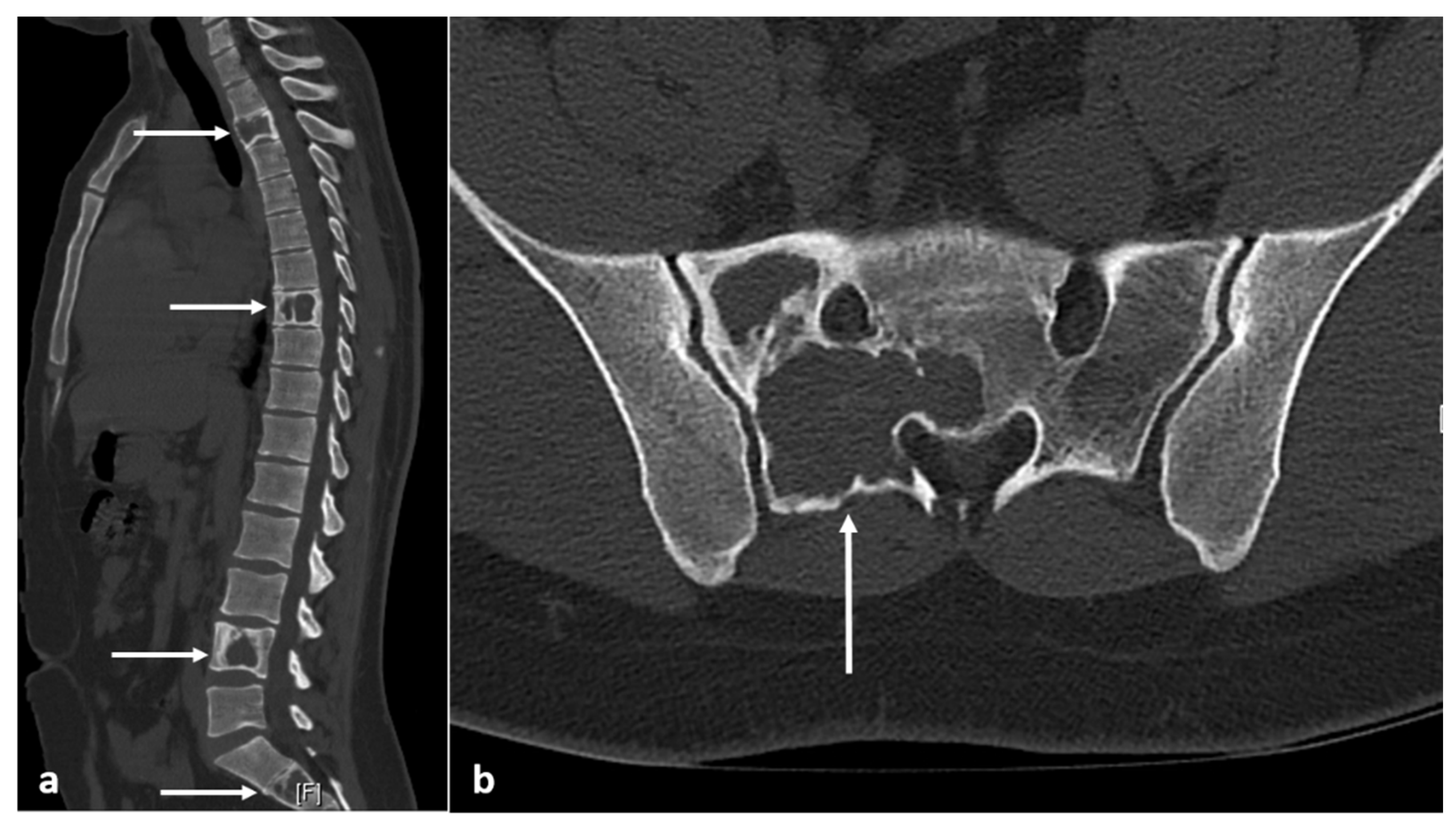 Diagnostics Free Full Text Primary Benign Neoplasms Of The Spine