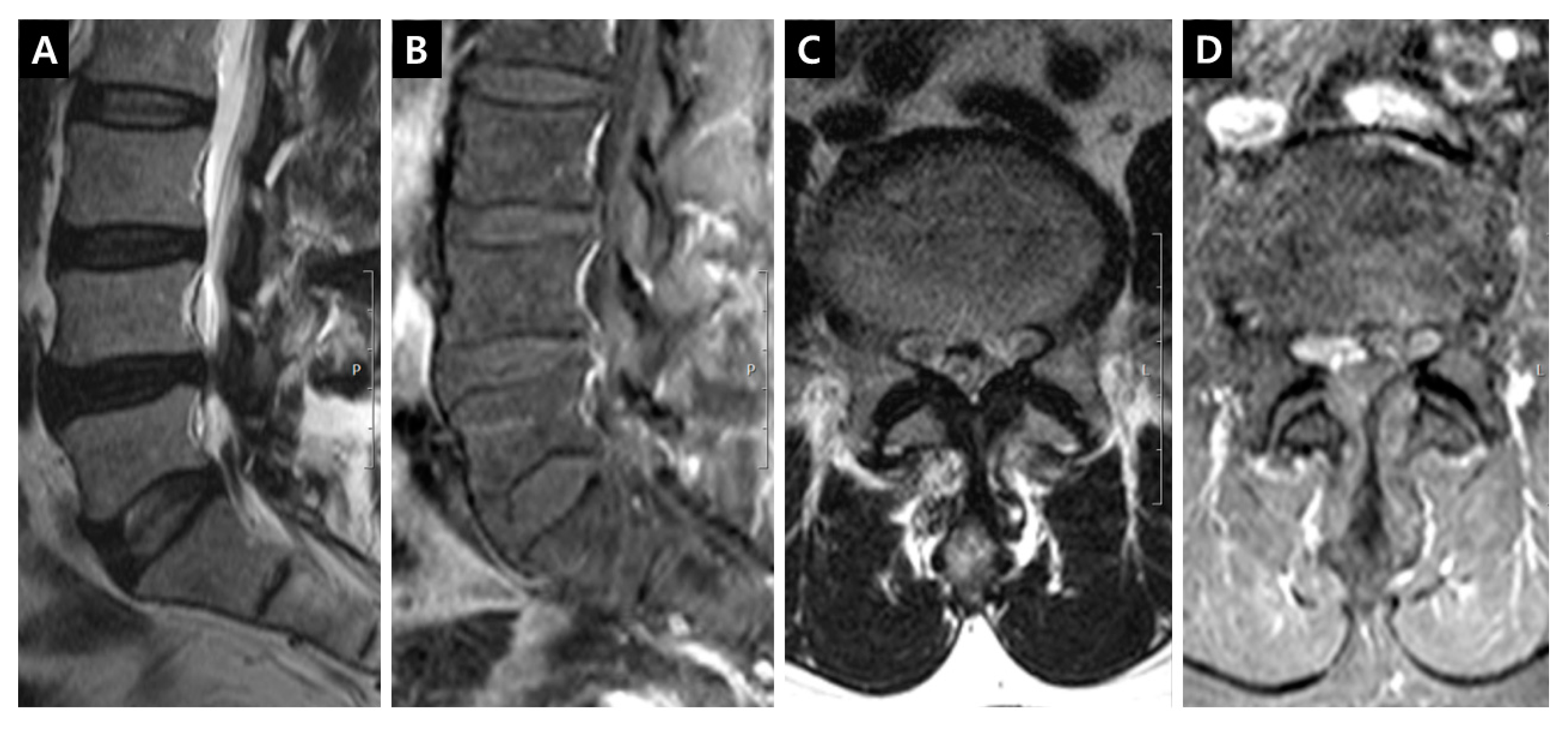 Jcm Free Full Text Quantification Of Lumbar Spinal Canal Stenosis By Quantitative Fat