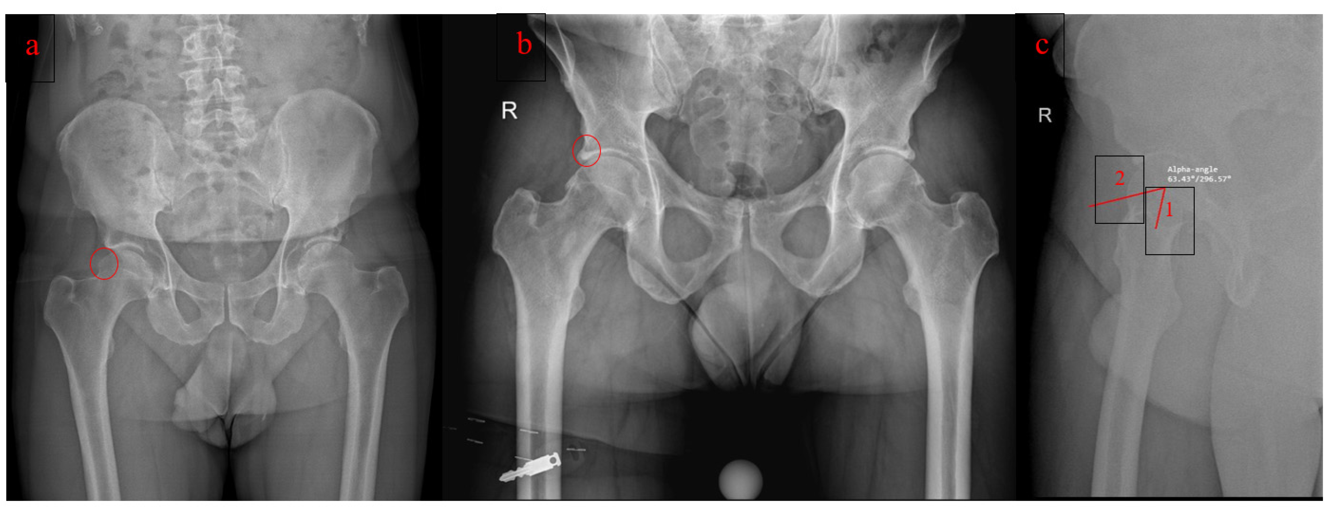 Jcm Free Full Text Conservative Vs Surgical Management For Femoro