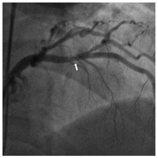 Medicina Free Full Text Near Infrared Spectroscopy Intravascular