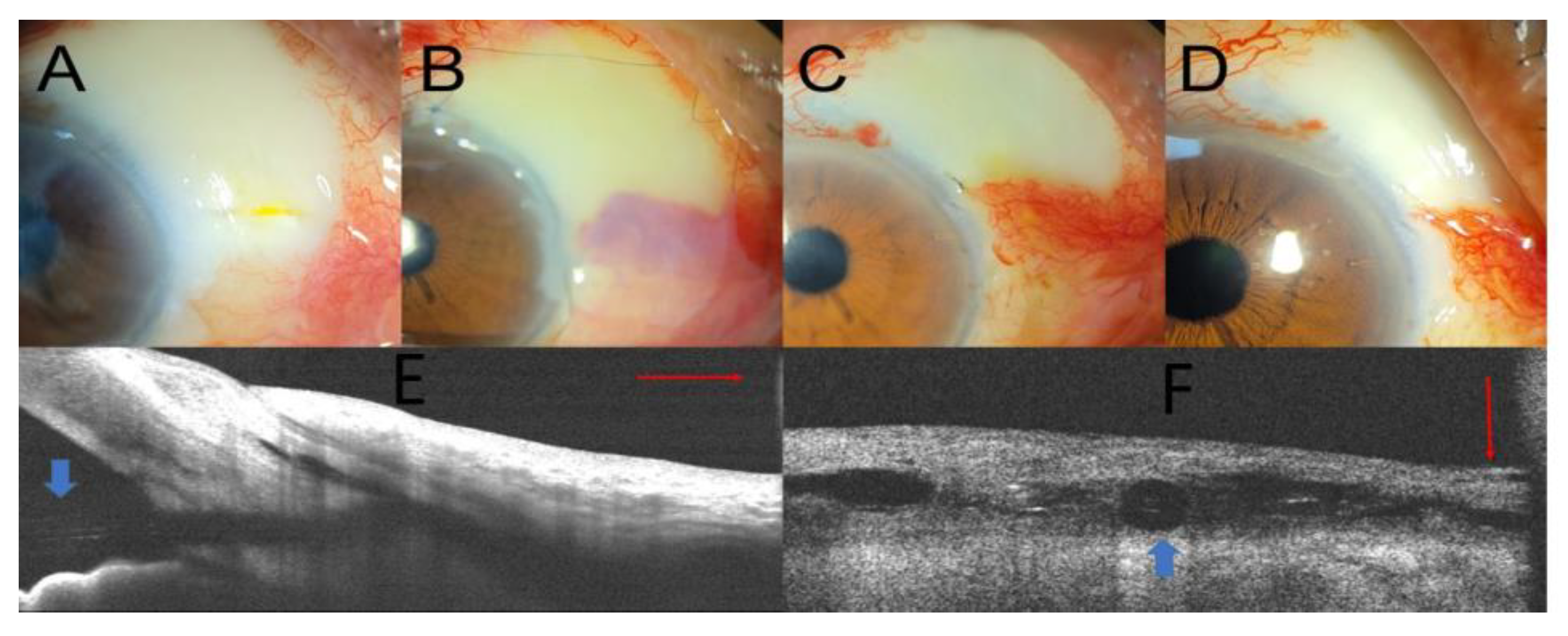 Management Of XEN Gel Stent Exposure With Conjunctival Erosion Via