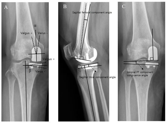 Medicina Free Full Text Spacer Block Technique Was Superior To