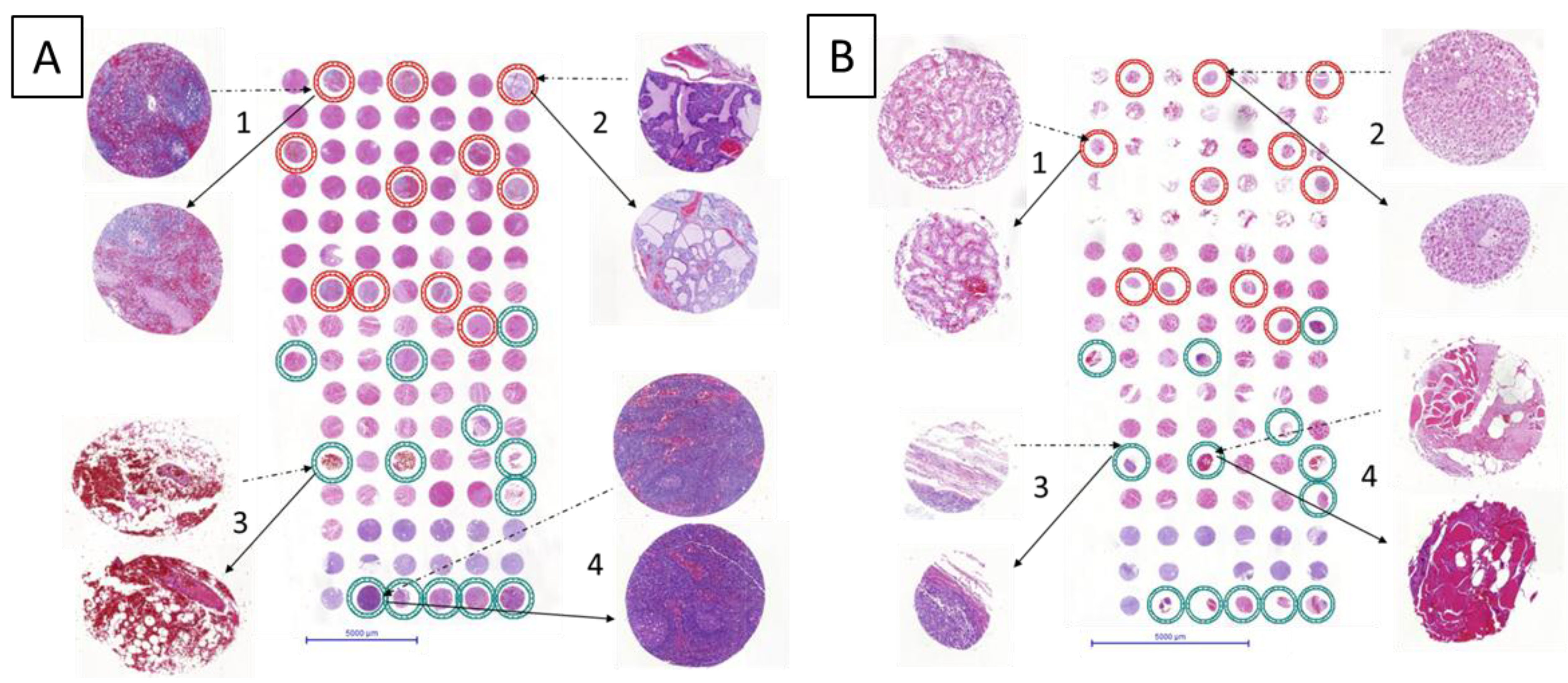 Microarrays | Free Full-Text | Re-Punching Tissue Microarrays Is