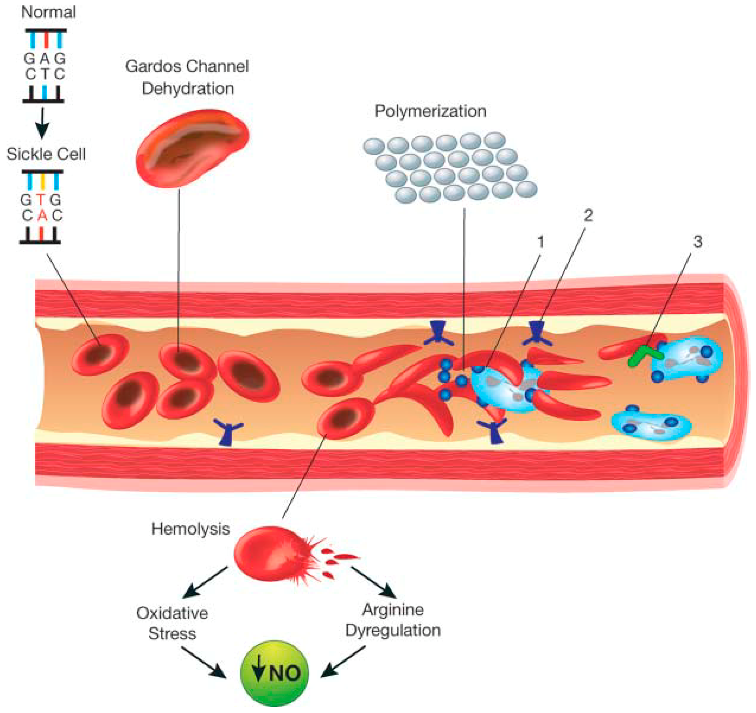 pleiotropy sickle cell anemia