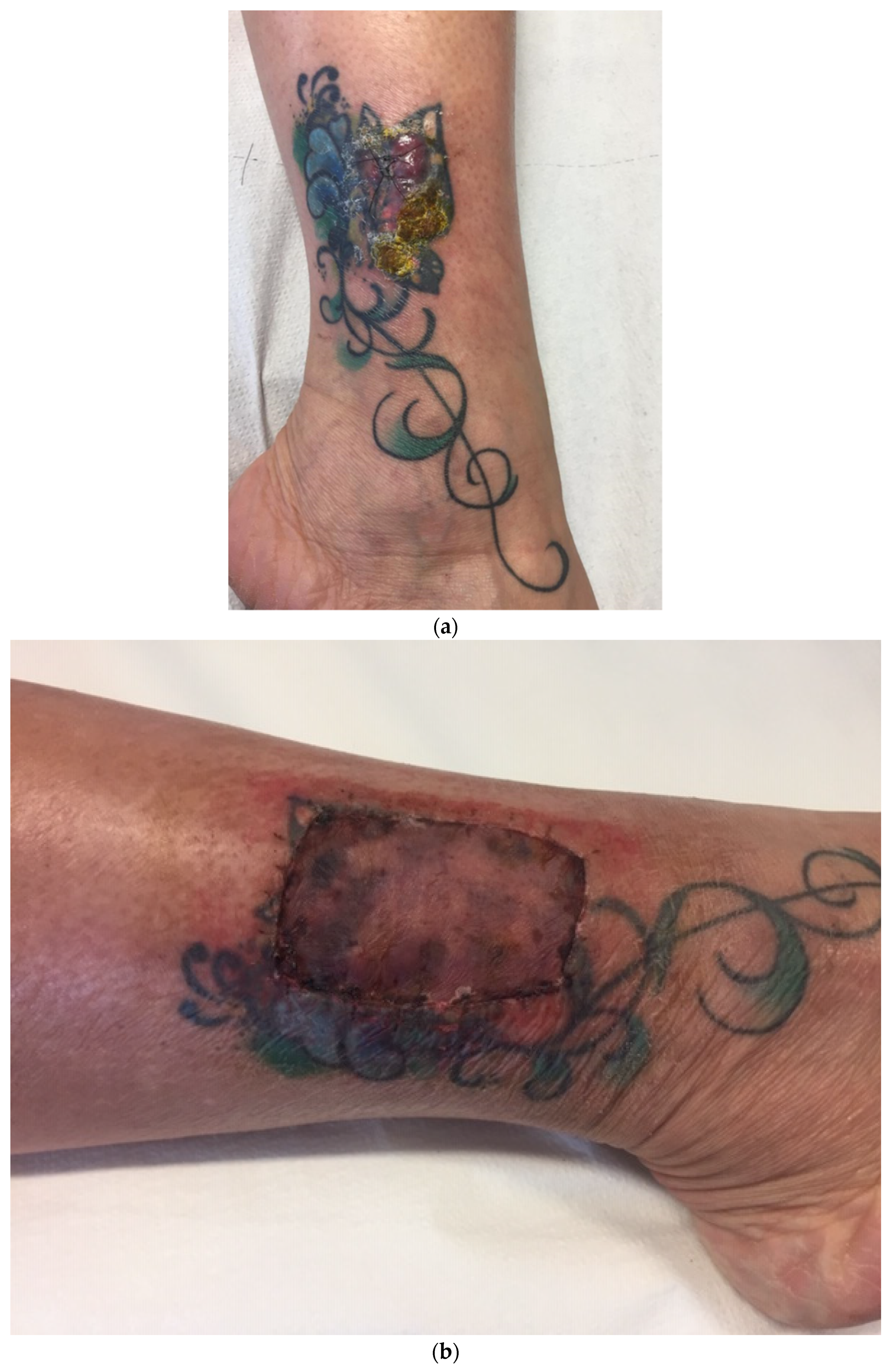 Diagnostic Approach for Suspected Allergic Cutaneous Reaction to a  Permanent Tattoo
