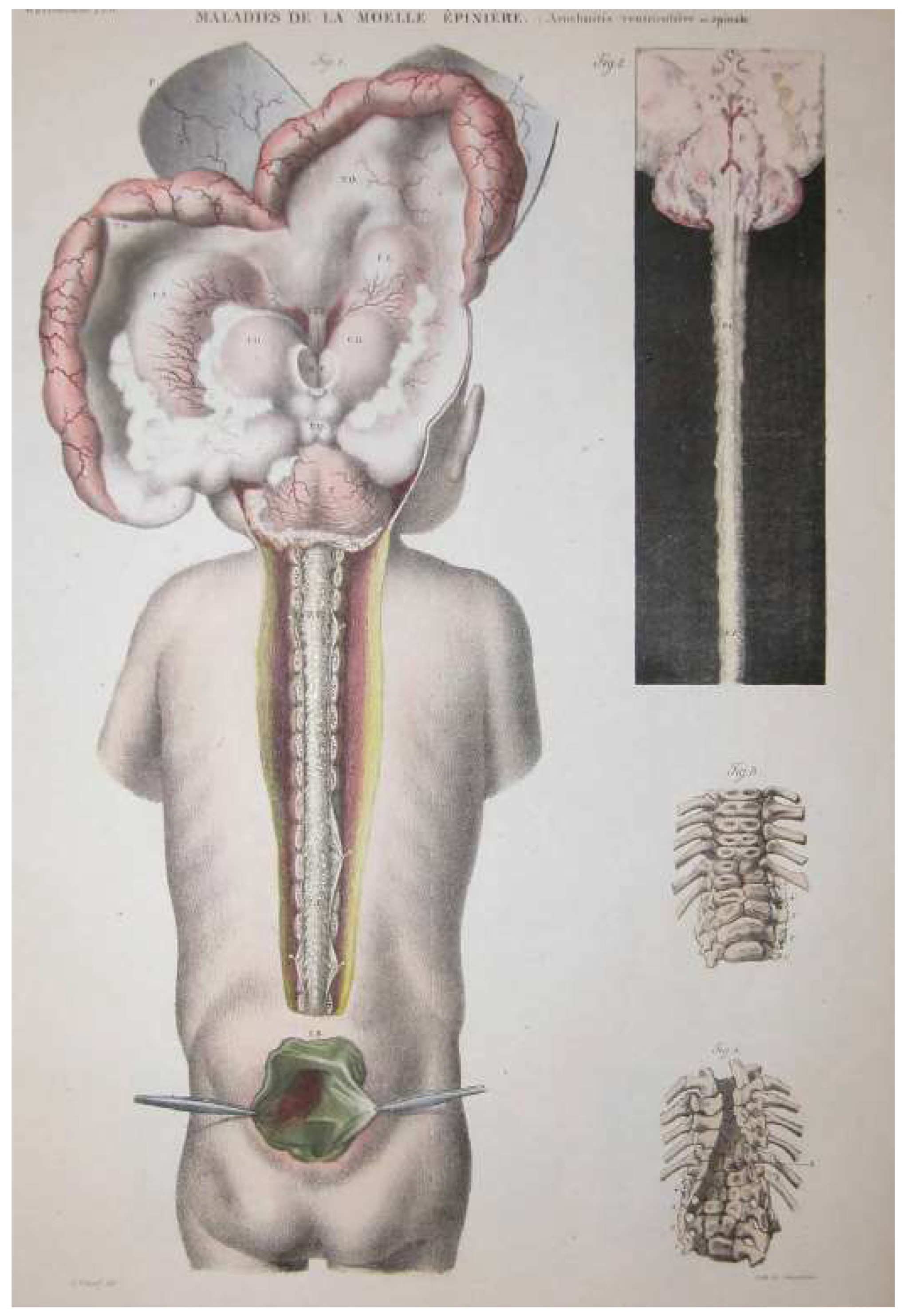 Anatomia | Free Full-Text | Jean Cruveilhier (1791&ndash;1874), a  Predecessor of Evidence-Based Medicine