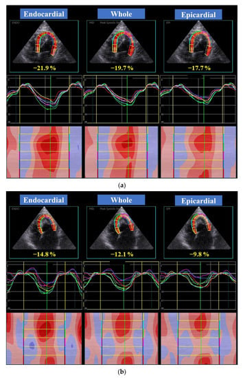 Normal range of myocardial layer-specific strain using two-dimensional  speckle tracking echocardiography