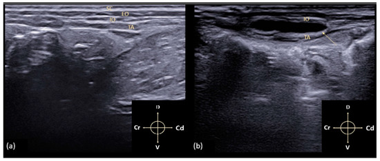 Frontiers  Ultrasound-guided transversus abdominis plane block as