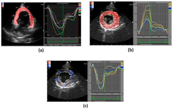 Color-coded polar diagram obtained by speckle-tracking echocardiography