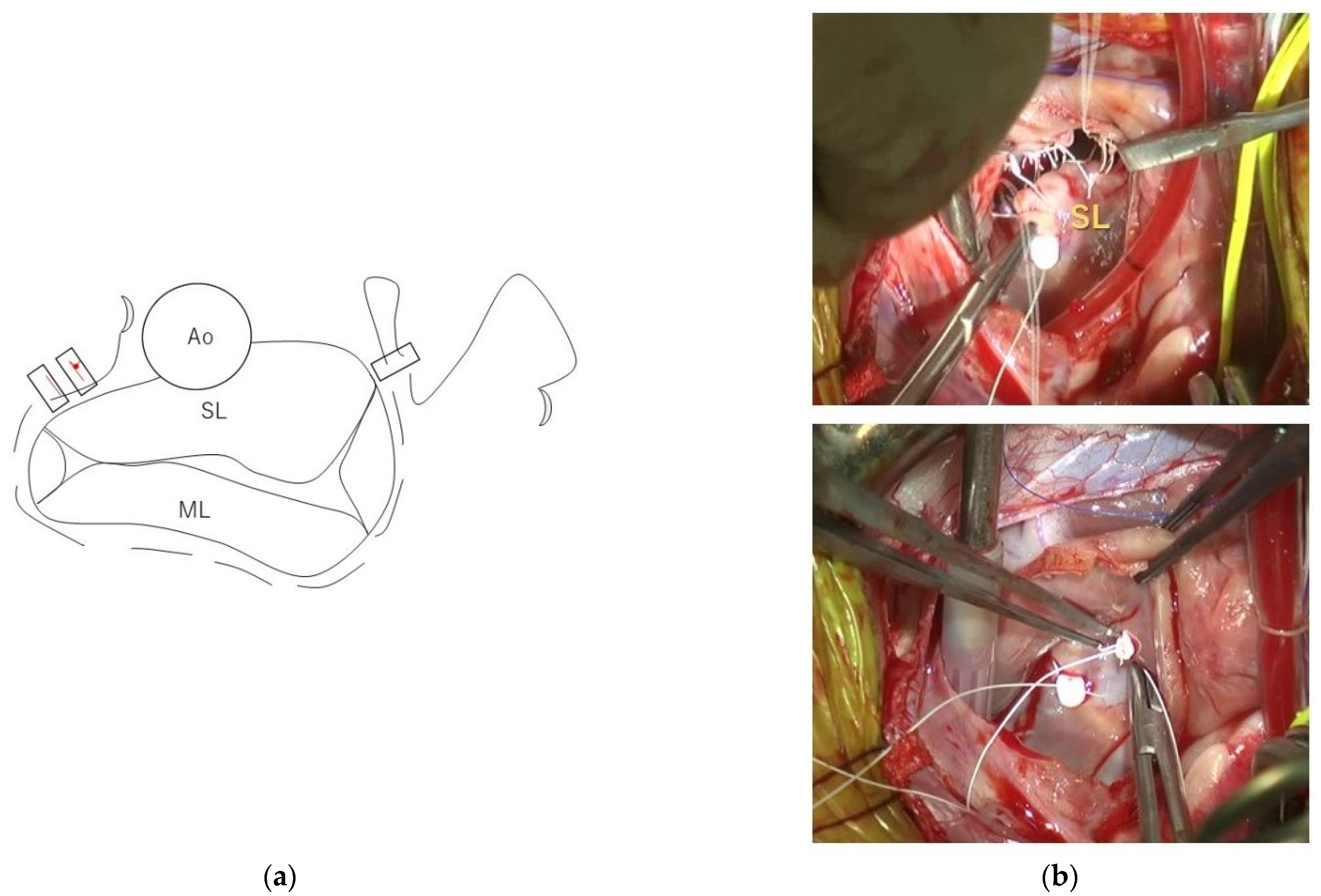 Figure 3 from Correction of rectal sacculation through lateral resection in  dogs with perineal hernia technique description | Semantic Scholar
