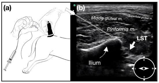 Ultrasound Guided Greater Ischiatic Notch Plane Block Combined  