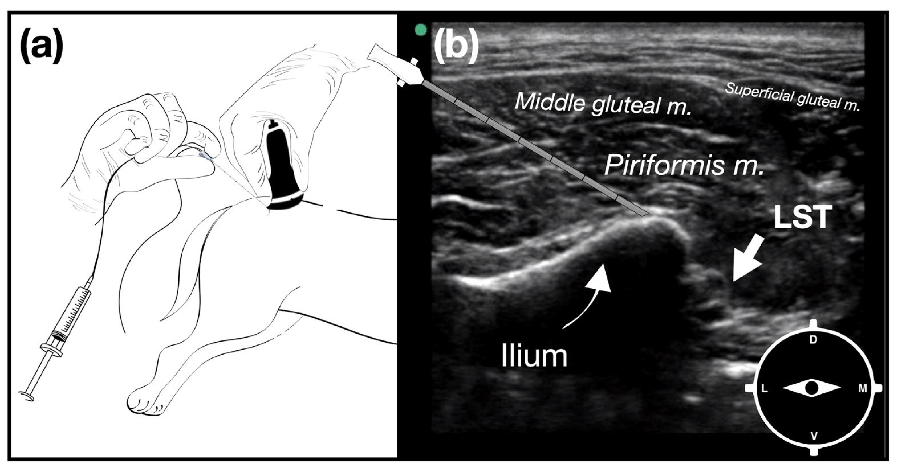 Ultrasound Guided Greater Ischiatic Notch Plane Block Combined  