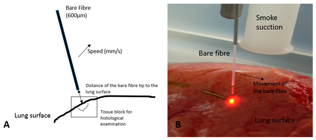 Applied Sciences | Free Full-Text | Local Effects on Lung Parenchyma Using  a 600 µm Bare Fiber with the Diode-Pumped Nd:YAG Laser LIMAX® 120 | HTML