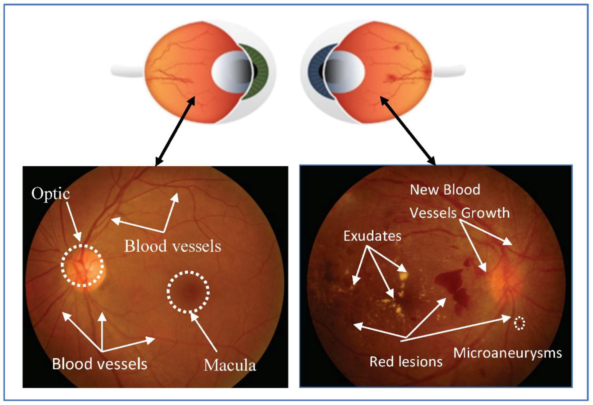Applied Sciences | Free Full-Text | Automated Diabetic Retinopathy  Screening System Using Hybrid Simulated Annealing and Ensemble Bagging  Classifier