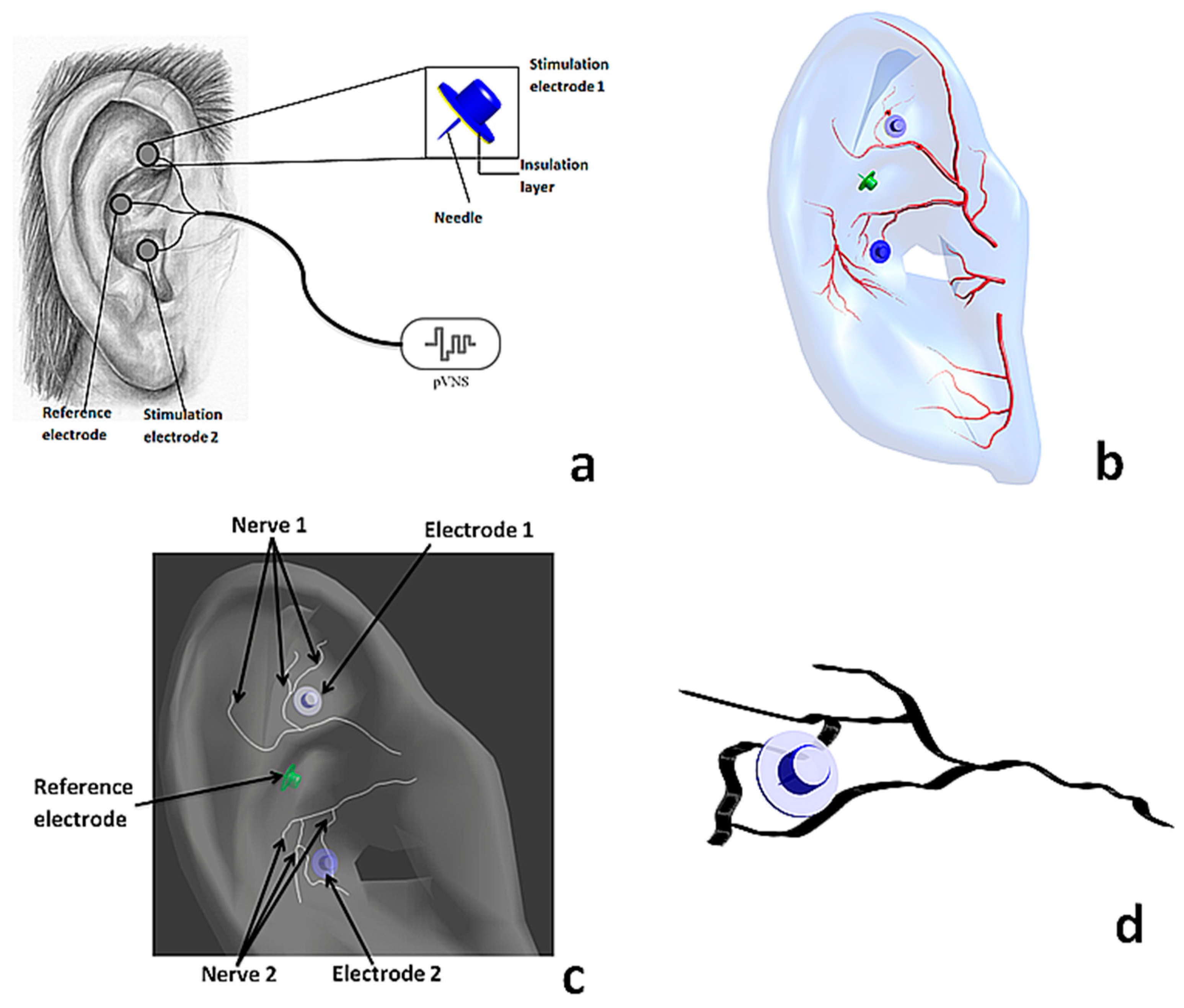A percutaneous auricular nerve stimulation system (NSS-2 Bridge