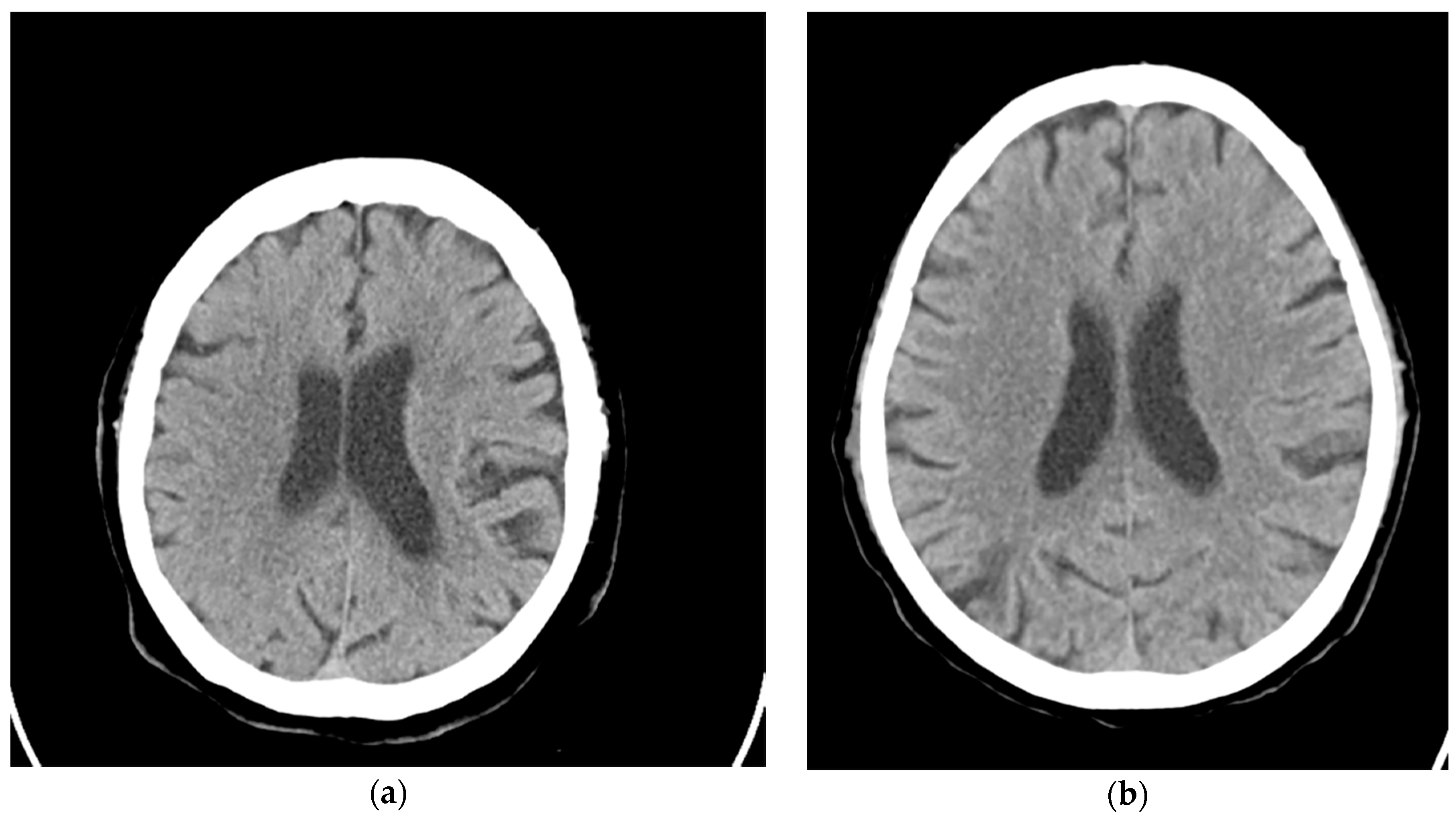 Applied Sciences | Free Full-Text | Computer-Aided Detection of Hyperacute  Stroke Based on Relative Radiomic Patterns in Computed Tomography