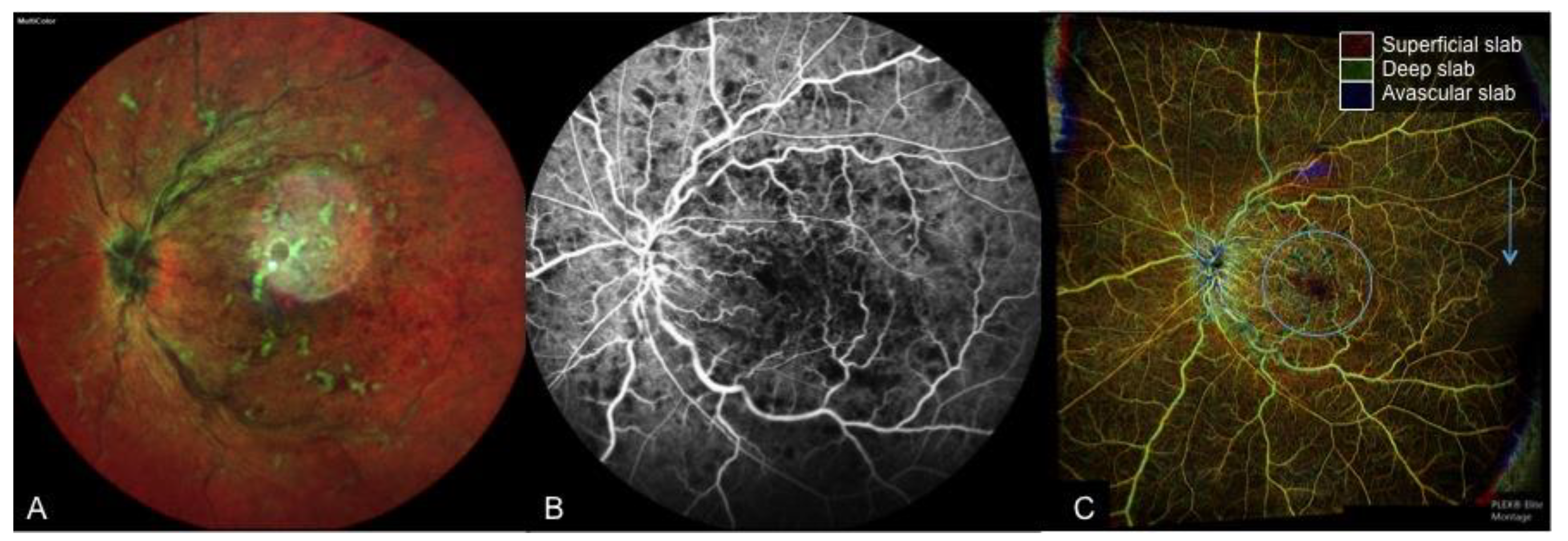 Applied Sciences Free Full Text Clinical Applications Of Optical Coherence Angiography Imaging In Ocular Vascular Diseases Html