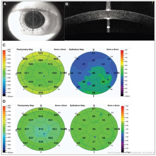 optical coherence tomography scan