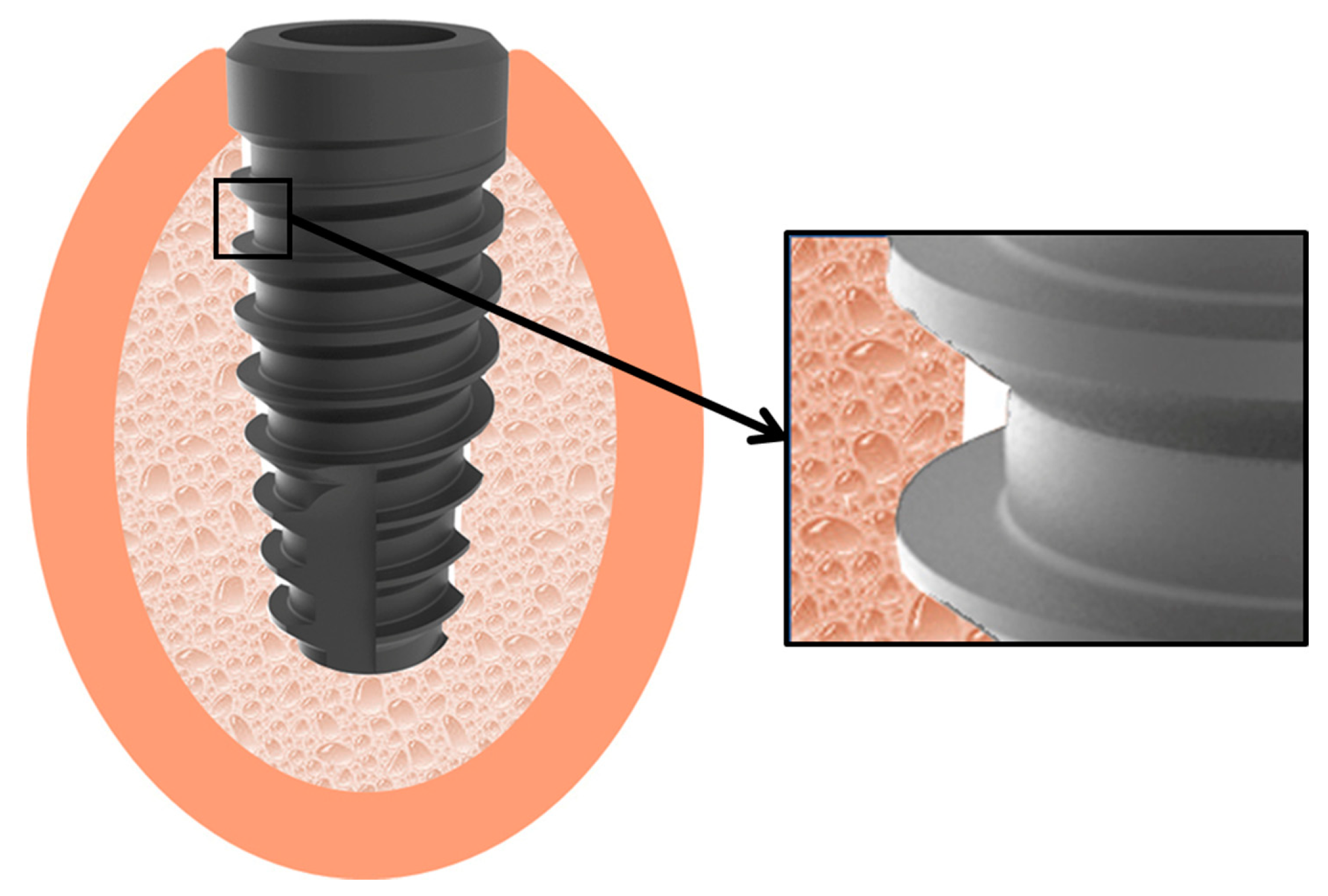 Applied Sciences | Free Full-Text | New Implant Macrogeometry To ...