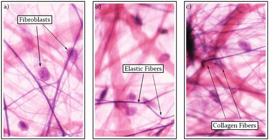 Morphology and definition of different grades of fibrosis in