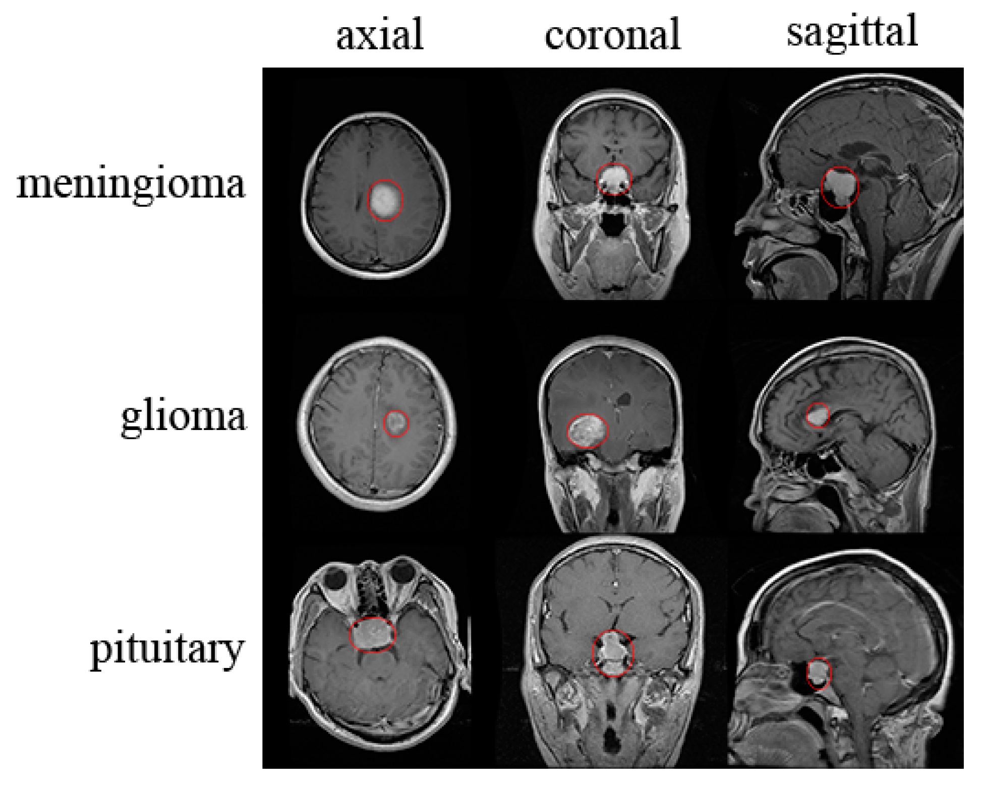MRI for brain tumors