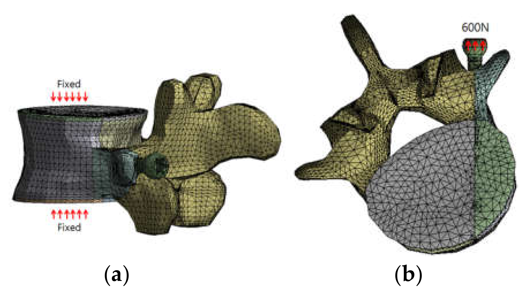 Applied Sciences Free Full Text Alternative Pedicle Screw Design Via Biomechanical Evaluation