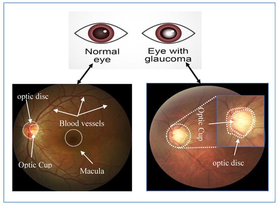 The grading system of optic disc images. (b) Outcomes of initial