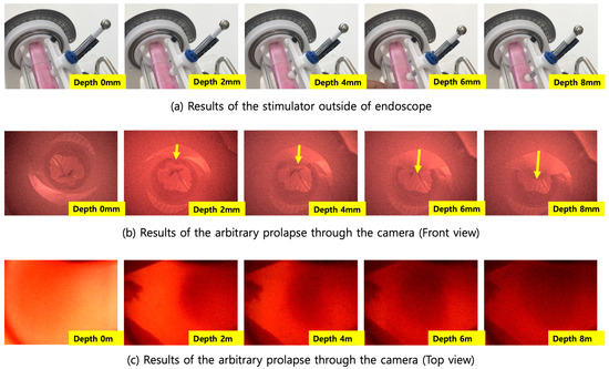 Applied Sciences Free Full-Text Evaluation of a Balloon-Type Vaginal Endoscope Based on Three-Dimensional Printing Technology for Self-Assessment of Pelvic Organ Prolapse