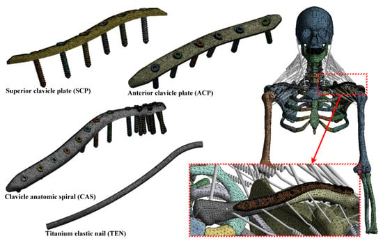 Thirteen models composed of three different clavicle hook plates, with