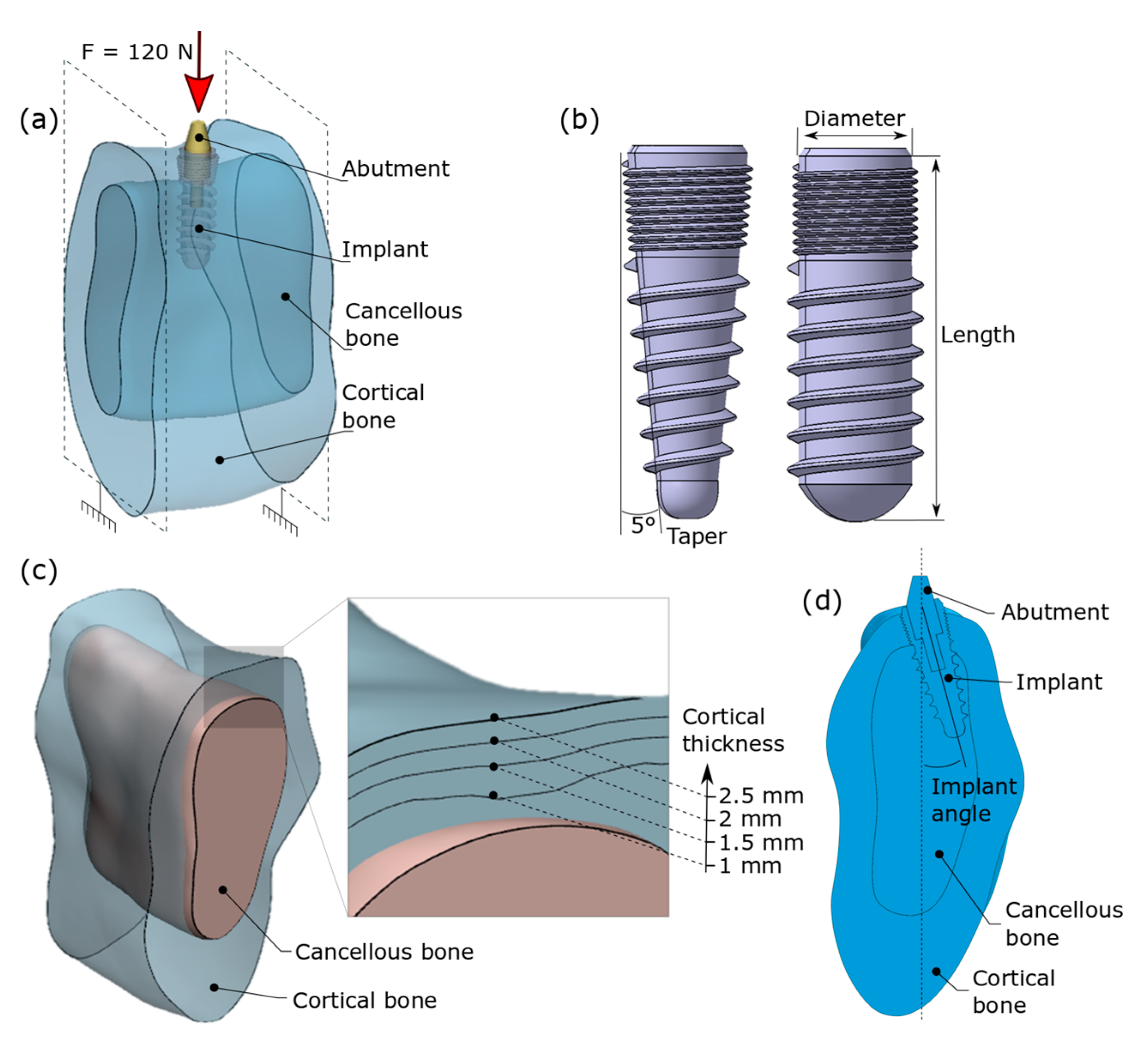 Applied Sciences | Free Full-Text | Finite Element Analysis of the Stress  Field in Peri-Implant Bone: A Parametric Study of Influencing Parameters  and Their Interactions for Multi-Objective Optimization