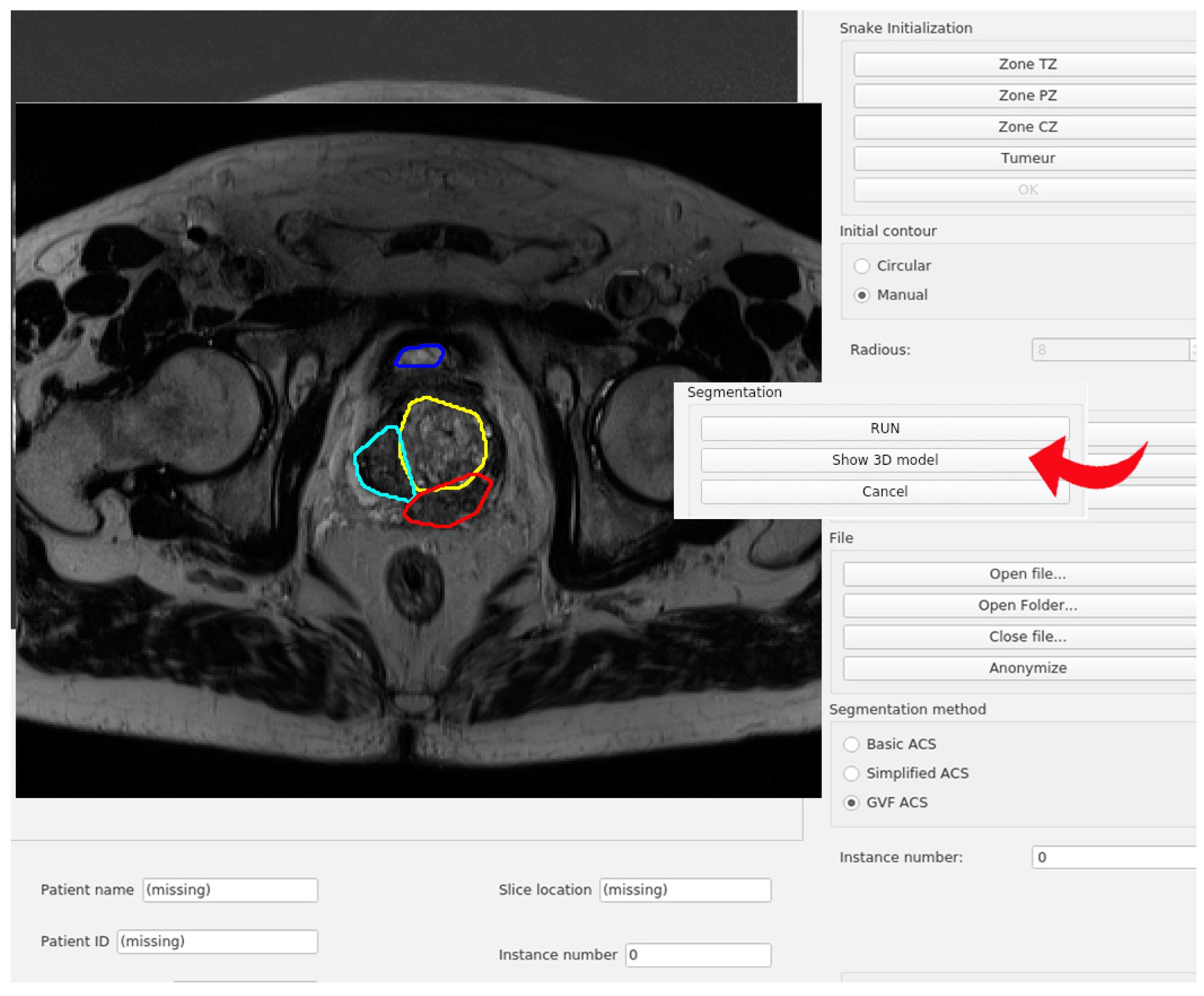 Applied Sciences | Free Full-Text | A Prostate MRI Segmentation Tool Based  on Active Contour Models Using a Gradient Vector Flow