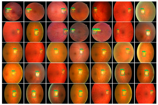 Applied Sciences Free Full Text Retinal Image Analysis For Diabetes Based Eye Disease 