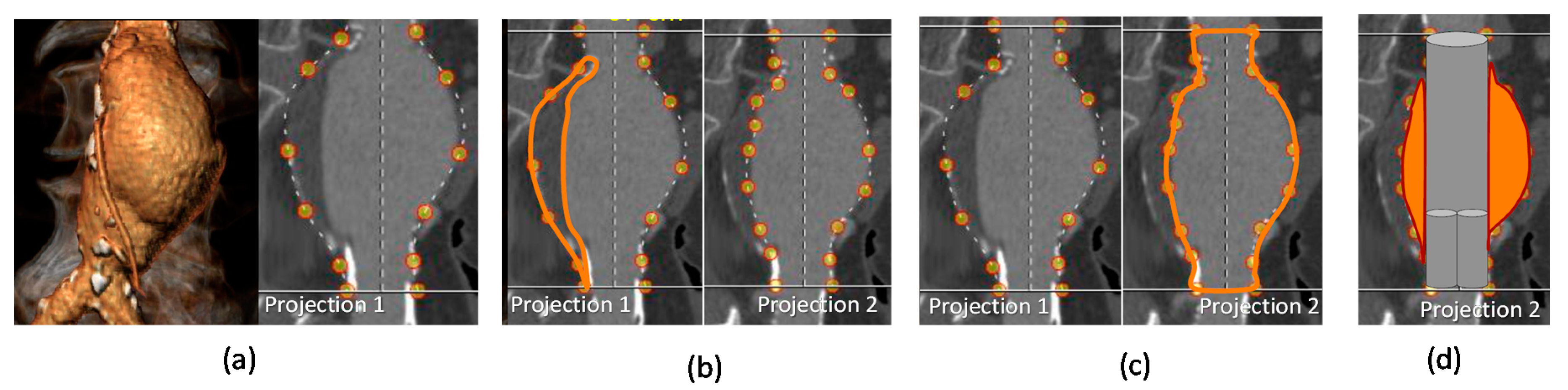 Applied Sciences Free Full Text Evar Ease An Easy To Use Software For Planning Sac Embolization In Endovascular Aneurysm Repair Procedure