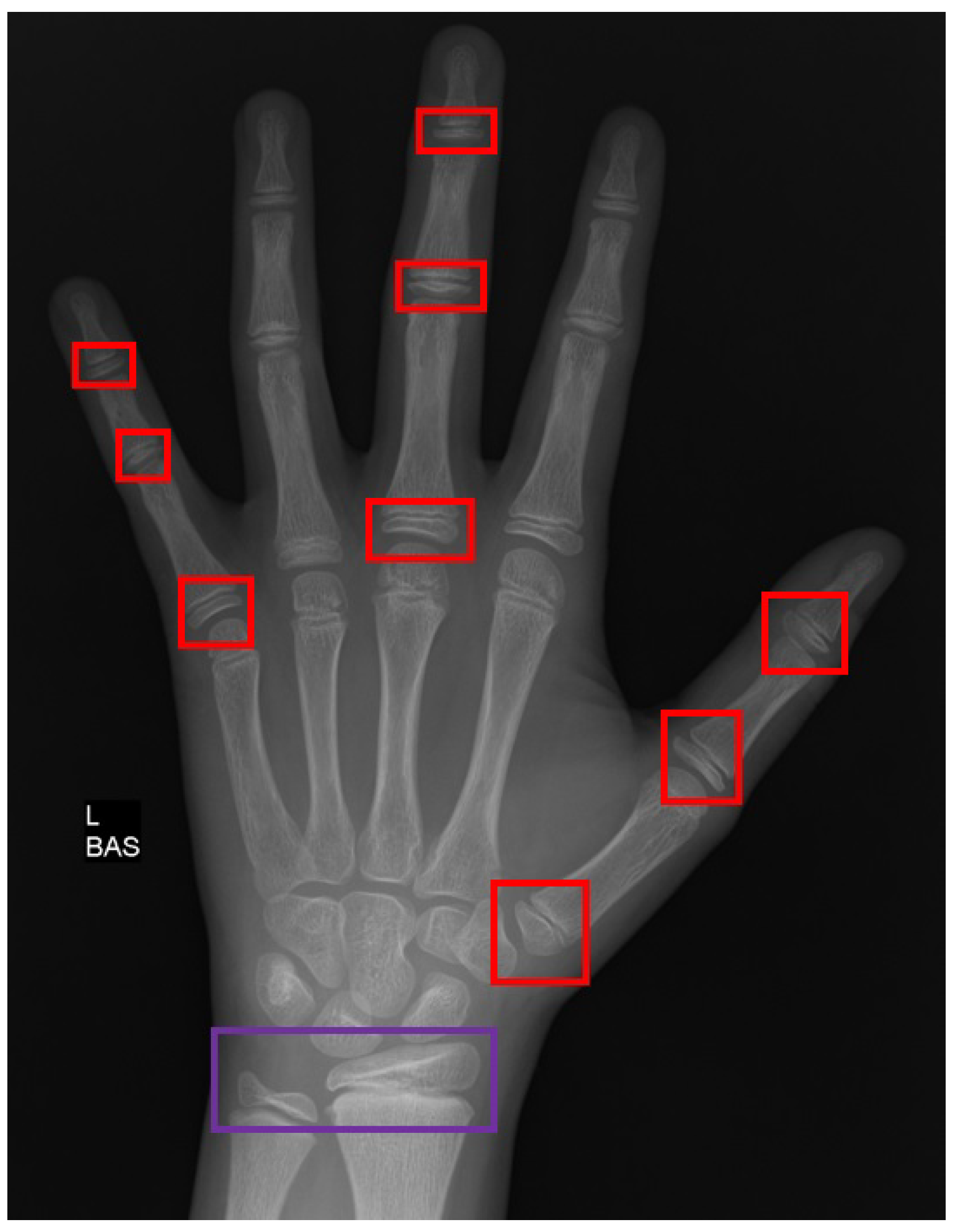 Applied Sciences | Free Full-Text | Automated Bone Age Assessment with  Image Registration Using Hand X-ray Images