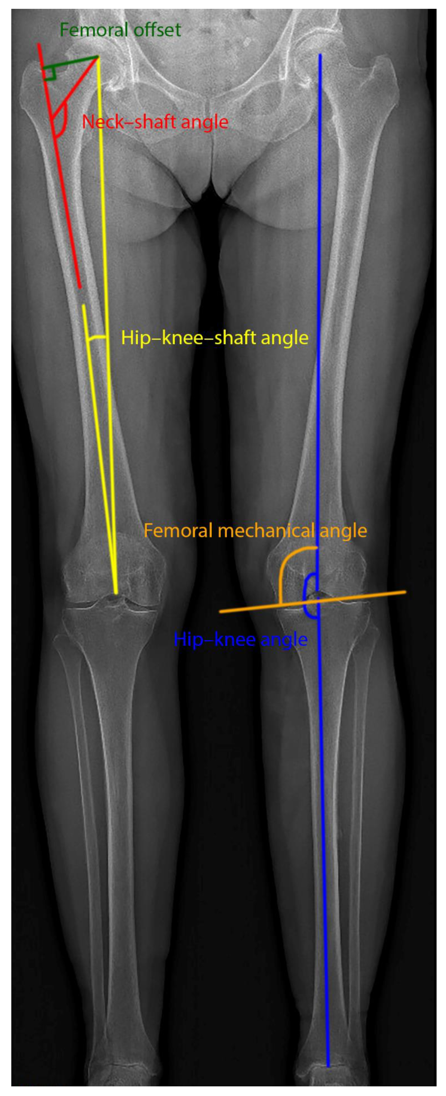 Applied Sciences | Free Full-Text | Determination of Leg Alignment in Hip  Osteoarthritis Patients with the EOS® System and the Effect on External  Joint Moments during Gait