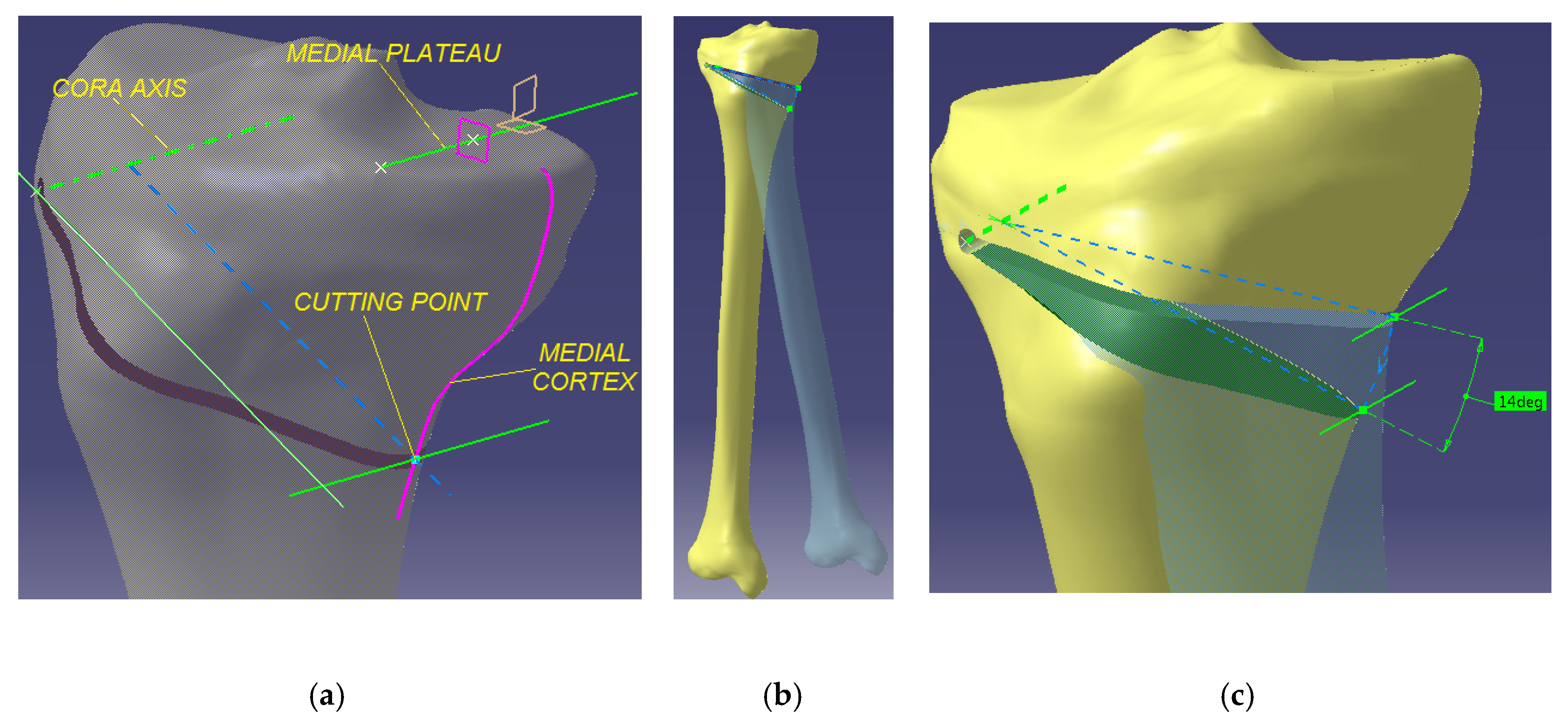 Applied Sciences | Free Full-Text | Medial Opening Wedge High Tibial  Osteotomy in Knee Osteoarthritis—A Biomechanical Approach