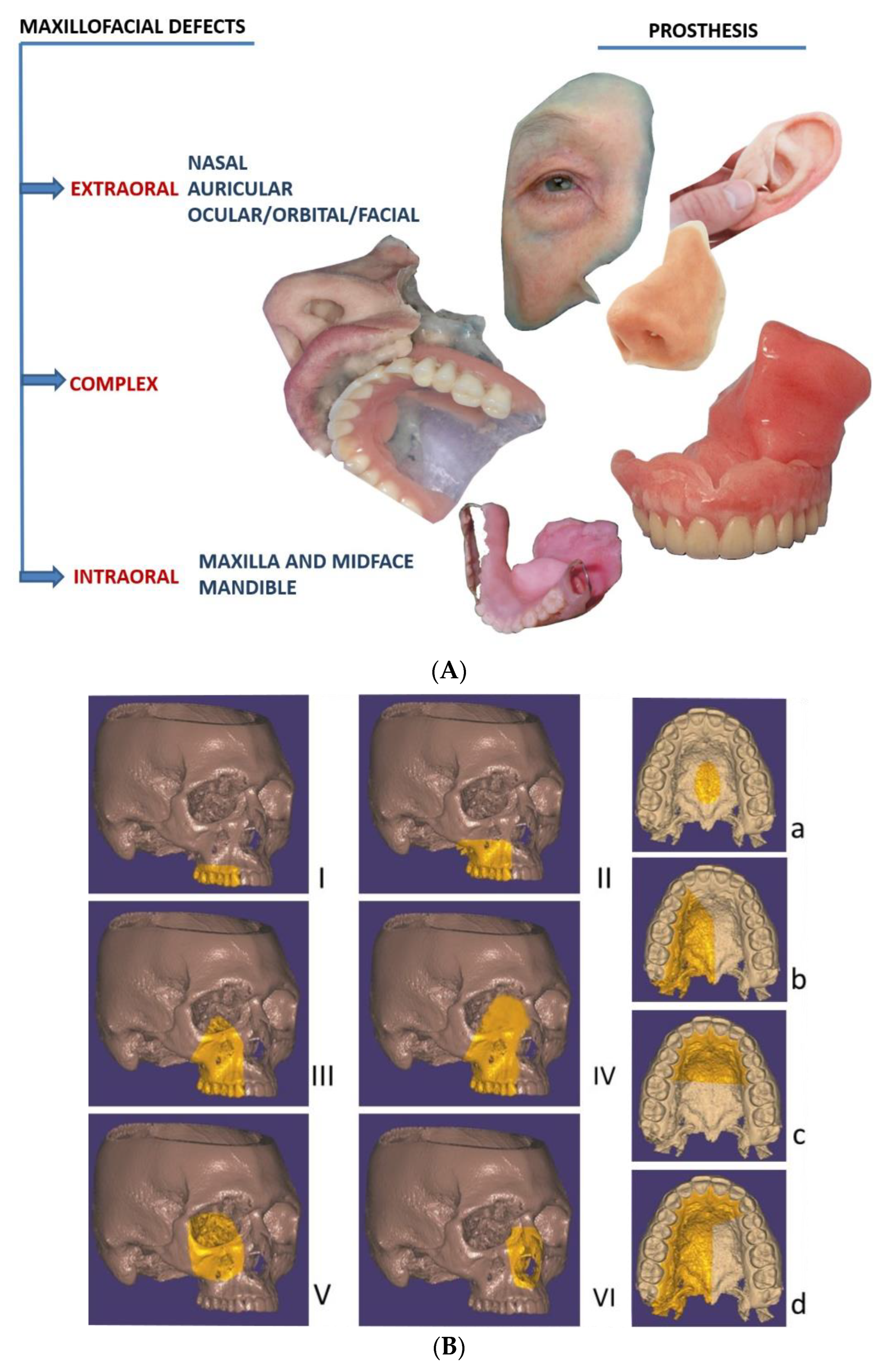 Applied Sciences | Free Full-Text | Digital Workflow in Maxillofacial  Prosthodontics—An Update on Defect Data Acquisition, Editing and Design  Using Open-Source and Commercial Available Software