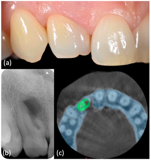 Applied Sciences | Free Full-Text | Print and Try Technique: 3D-Printing of  Teeth with Complex Anatomy a Novel Endodontic Approach | HTML