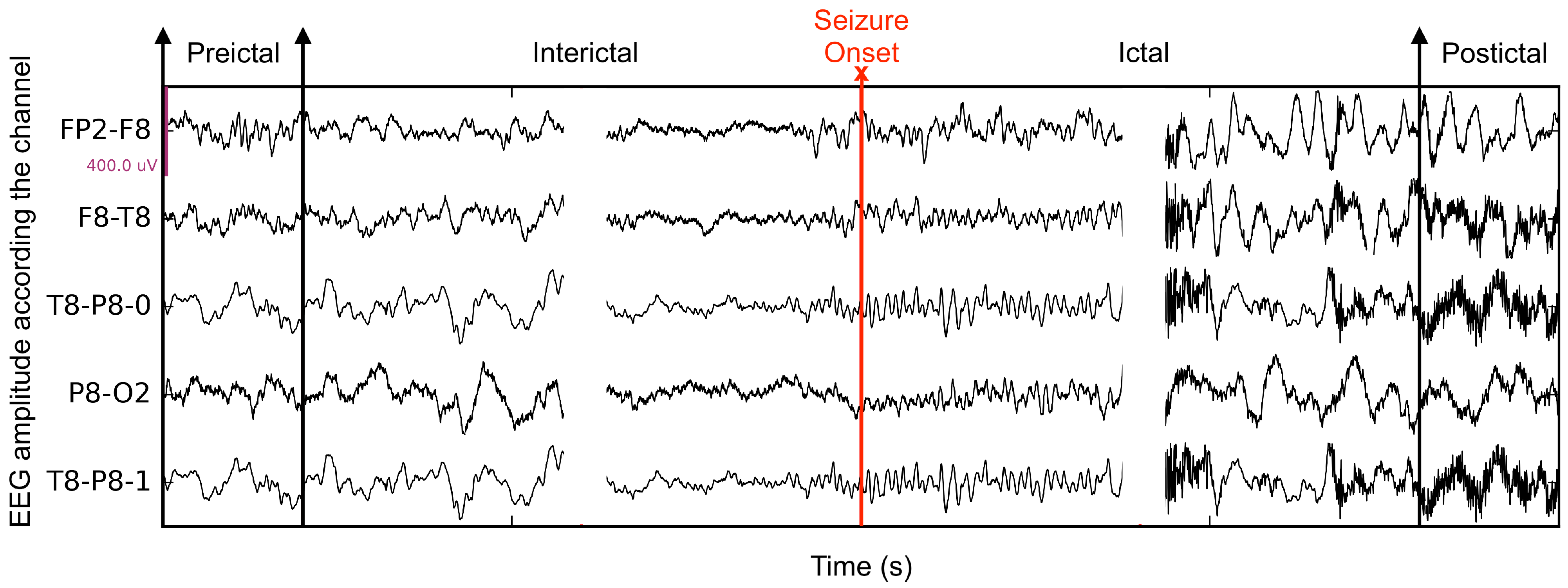 Applied Sciences | Free Full-Text | A Study of EEG Feature Complexity in  Epileptic Seizure Prediction