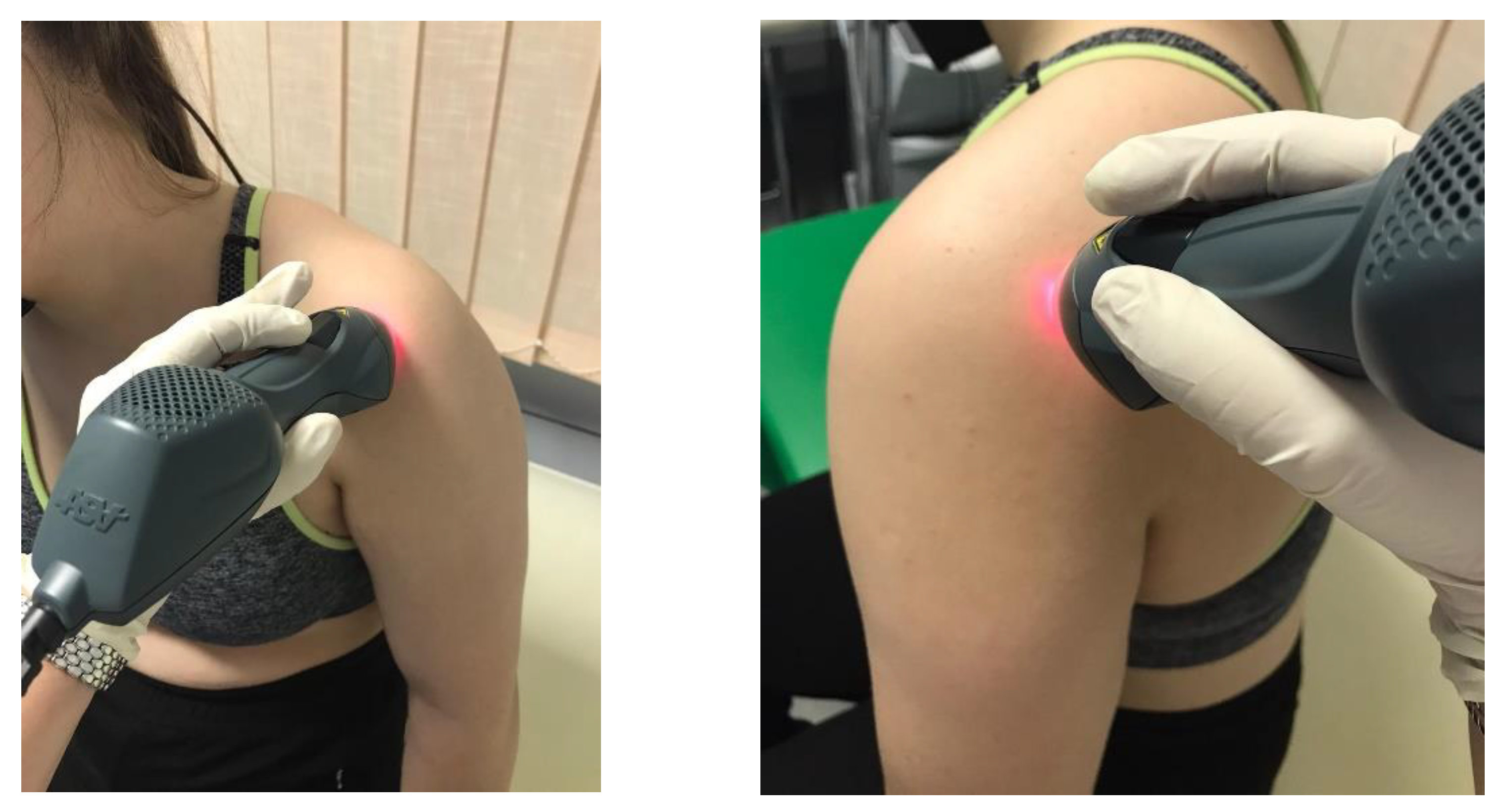 Applied Sciences | Free Full-Text | The Short-Term Outcomes of Multiwave  Locked System (MLS) Laser Therapy versus a Combination of Transcutaneous  Nerve Stimulation and Ultrasound Treatment for Subacromial Pain Syndrome
