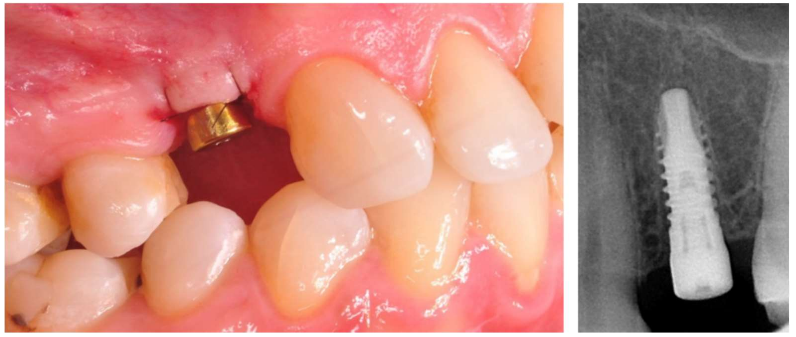 Applied Sciences Free Full-text Early Loading Of Titanium Dental Implants With Hydroxyl Ion Modified Surface A 12-month Prospective Clinical Trial Html